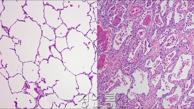 폐 현미경 사진 왼쪽 정상, 오른쪽 코로나19 환자.jpg